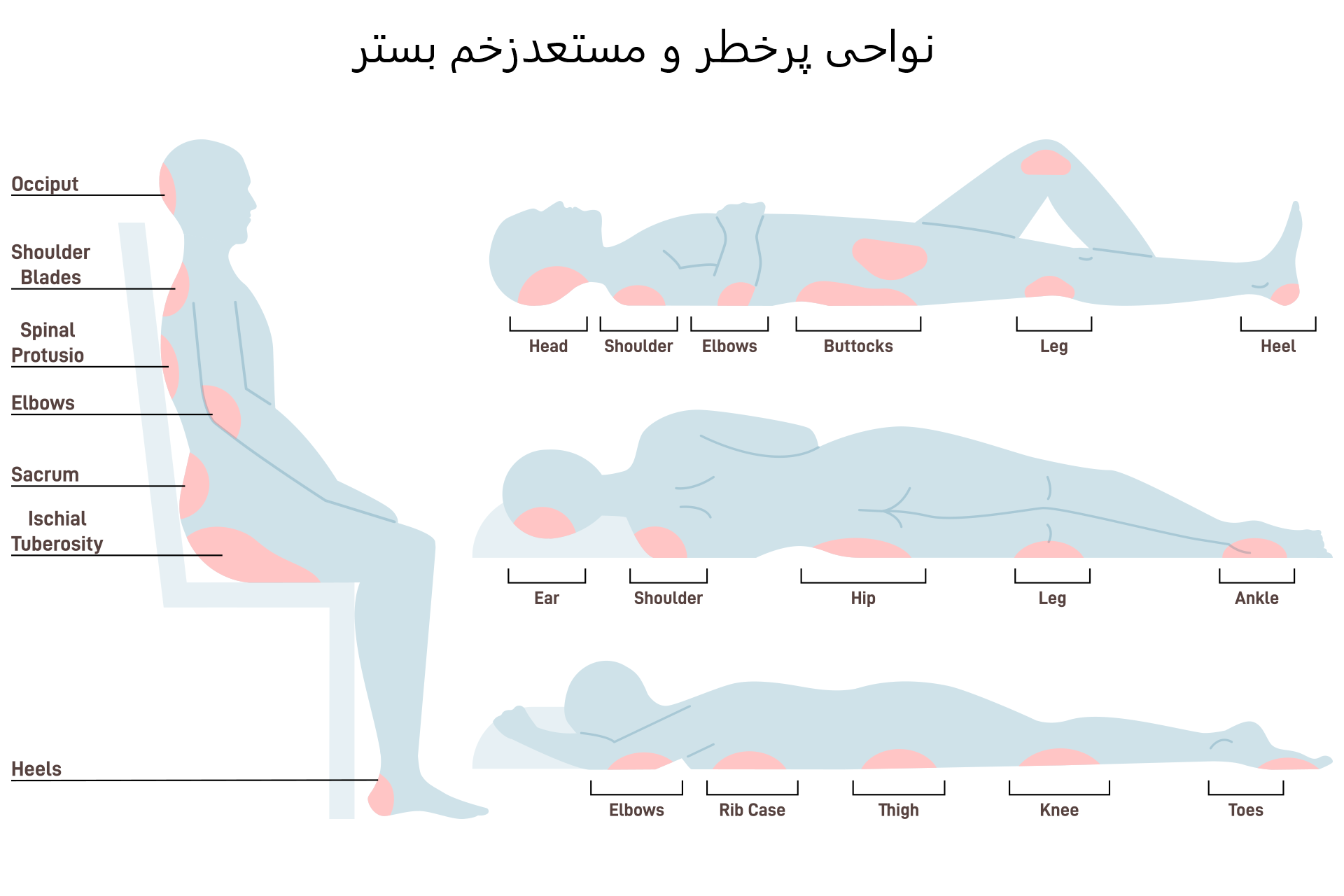 نواحی مستعد زخم بستر مرحله 4