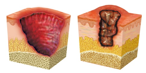 عکس انواع زخم بستر چگونه است؟